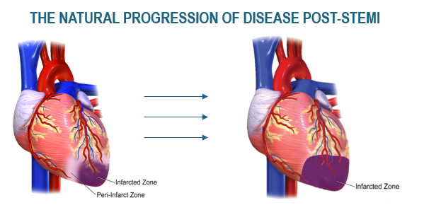 Progression Post Stemi